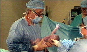 Caesarean