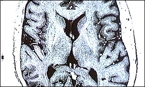 brain lobes