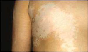 The condition creates patches on the skin