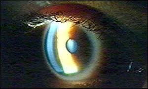 Multiple drops cause problems for glaucoma patients