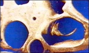 Bone scan
