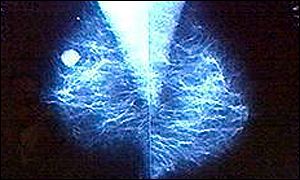 Breast tumour