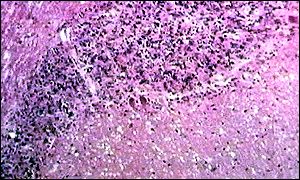 CJD makes the brain 'spongy'