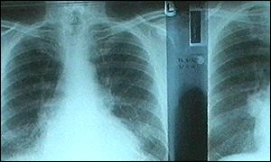 Lung x-ray