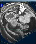 Cancerous tumour
