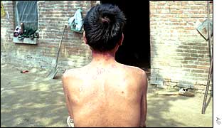 Chinese Aids victim