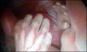 Foetus