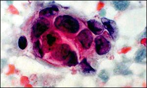 Breast cancer cells