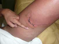 fin injury