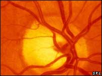 Retina