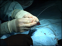 Catheter