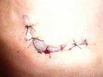 fin injury