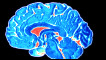CT scan of a brain
