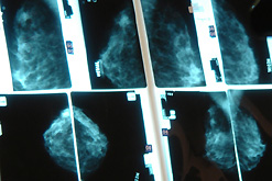Image: breast check