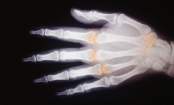 An xray of a hand showing swollen joints
